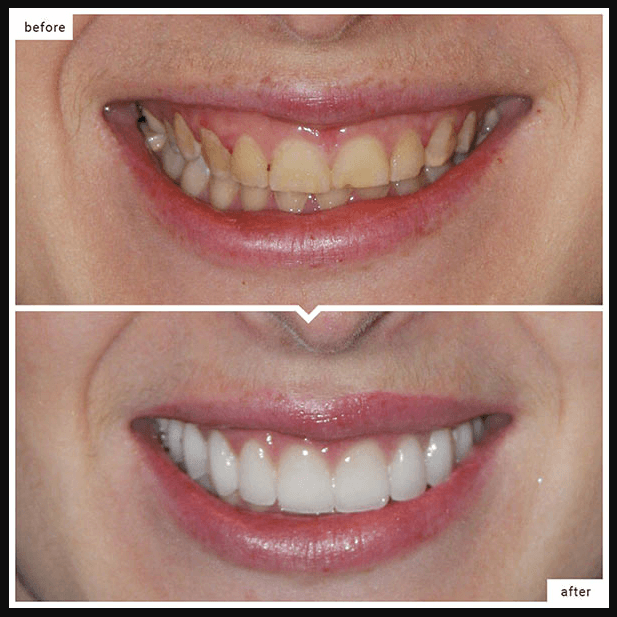 before and after